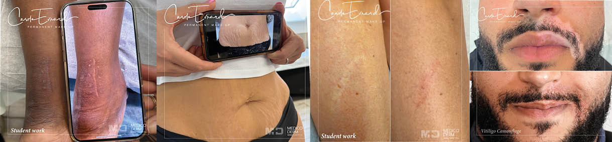camouflage cicatrices - vitiligo - vergetures par Carole Evrard