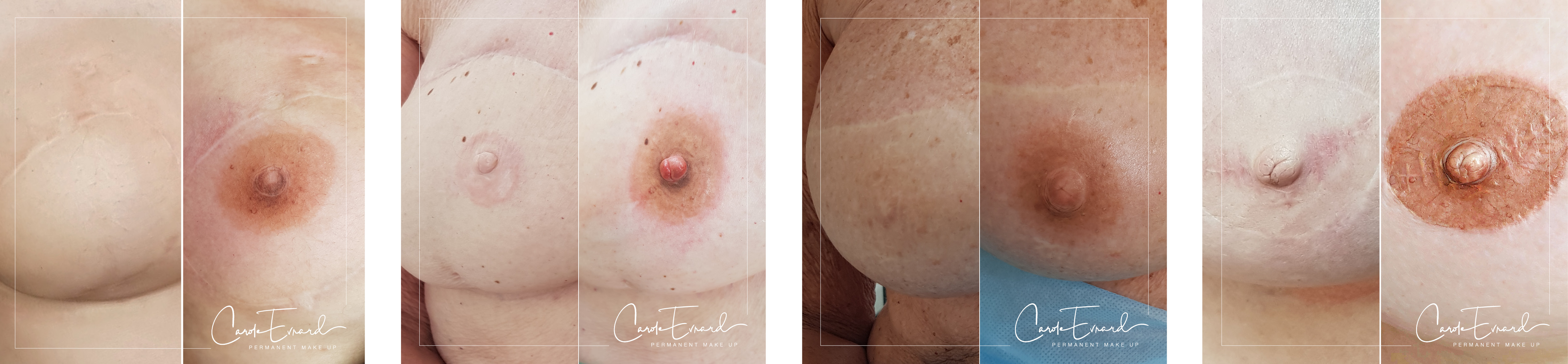 Reconstruction d'aréole mammaire par dermopigmentation - Carole Evrard, Medico Derm Academy